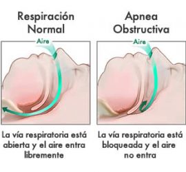 Anatomía Apnea